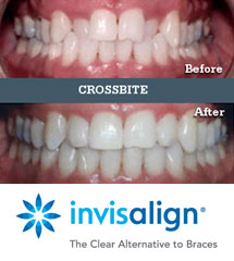 Seabright Family and Implant Dentistry | Invisalign | Crossbite