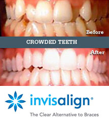 Seabright Family and Implant Dentistry | Invisalign | Crowding