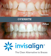 Seabright Family and Implant Dentistry | Invisalign | Overbite